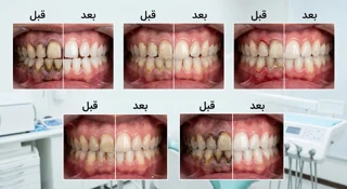جرم گیری و بروساژ