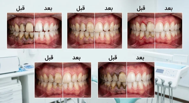 جرم گیری و بروساژ