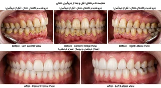 جرم گیری و بروساژ