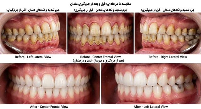 جرم گیری و بروساژ