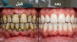 جرم گیری و بروساژ