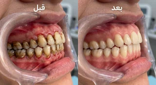 جرم گیری و بروساژ